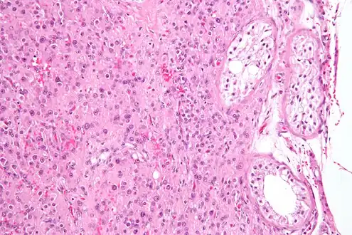 Intermediate magnification micrograph of a Leydig cell tumour. H&E stain.