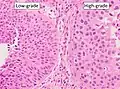 Transitional cell carcinoma, being low-grade to the left, and high-grade to the right. H&E stain