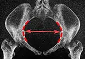 Low-dose CT scan of the transverse diameter of the pelvic inlet, as part of pelvimetry