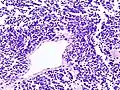 Histopathologic image of small-cell carcinoma of the lung. CT-guided core needle biopsy.