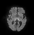 Axial MRI B=1000 DWI image showing hyperintense signal indicative of restricted diffusion in the mesial dorsal thalami