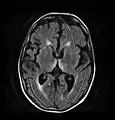 Axial MRI FLAIR image showing hyperintense signal in the mesial dorsal thalami, a common finding in Wernicke encephalopathy.  This patient was nearly in coma when IV thiamine was started, he responded moderately well but was left with some Korsakoff type deficits.