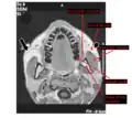 Horizontal MRI scan of a head, at the level of the mandibular teeth, showing the masseter muscle and neighbors.