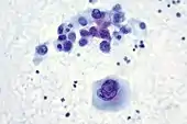 Malignant melanoma, fine-needle aspiration biopsy of the liver, direct Smear.