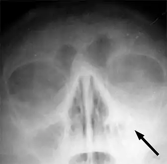 X-ray of left-sided maxillary sinusitis marked by an arrow. There is lack of the air transparency indicating fluid in contrast to the other side.