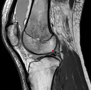 Posterior meniscofemoral ligament (Wrisberg) behind the posterior horn of the lateral meniscus close to its insertion. Sometimes wrongly interpreted as a meniscal tear.