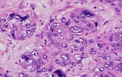 Invasive ductal carcinoma with marked nuclear pleomorphism.