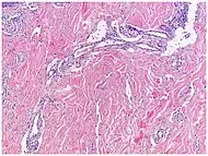 Micrograph of promontory sign in Kaposi's sarcoma in patch stage. Dilated irregular vascular channels surround a pre-existing vessel.