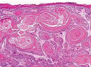 Well-differentiated (yet invasive) cSCC, showing prominent keratinization. It may form pearl-like structures where dermal nests of keratinocytes attempt to mature in a layered fashion. Well-differentiated cSCC has slightly enlarged hyperchromatic nuclei with abundant amounts of cytoplasm. Intercellular bridges will frequently be visible.