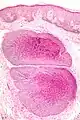 Low-magnification micrograph of molluscum contagiosum, H&E stain