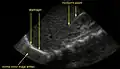 A normal ultrasonographic view of Morison's pouch.  The bright line is the capsule of the kidney; there is no fluid present and hence no visible space.