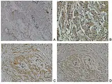 Neuropilin-2 expression in normal breast and breast carcinoma tissue