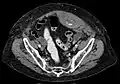 Rectus sheath hematoma seen on axial CT – with active bleeding under Marcoumar