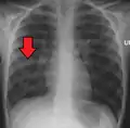 Right middle lobe pneumonia in a child as seen on plain X-ray