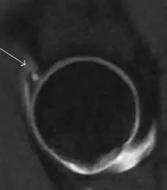 Sagittal T1 weighted image showing anterosuperior labral tear.