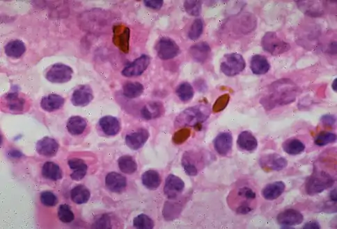 Hamazaki–Wesenberg bodies in sarcoidosis in lymph node