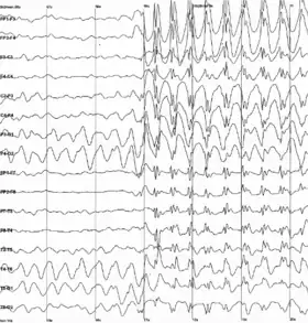 An electroencephalogram of a person with childhood absence epilepsy showing a seizure. The waves are black on a white background.