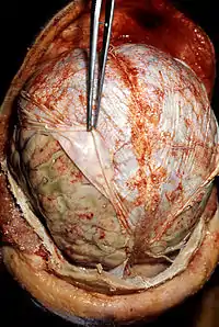 Acute infective meningitis