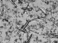 Struvite crystals in a human urine sample with a pH of 9. Abundant amorphous phosphate crystals, several squamous and non-squamous epithelial cells and a few leukocytes can also be observed.