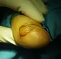 Subungual exostosis (2/3)