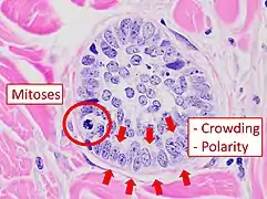 Cellular arrangement, including crowding and cell polarity (common tendencies among cells at the border, such as elongation or "palisading" in this case). Amount of mitoses can also be appreciated at this level.