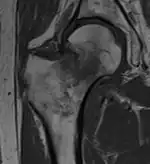 T1-weighted turbo spin echo MRI confirms a fracture, as the surrounding bone marrow has low signal from edema.