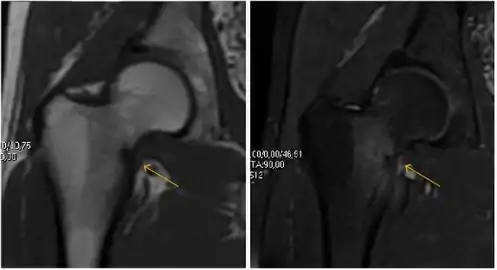 Furthermore, T1 (left) and DP fat saturated (right) weighted MR images showed the fracture line and a pattern of edema.