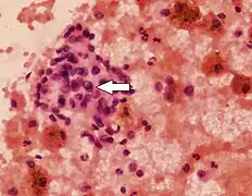 Category V with intranuclear cytoplasmic inclusion