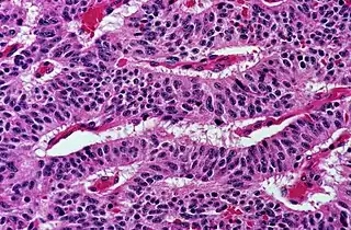 Trabecular, elongated (rod-shaped) groups of cells.