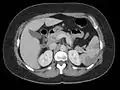 Thrombus of the left ventricle resulting in embolism of the spleen