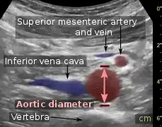 Aortic measurement on abdominal ultrasonography in the axial plane between the outer margins of the aortic wall