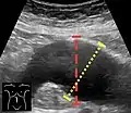 Ultrasonography in the sagittal plane, showing axial plane measure (dashed red line), as well as maximal diameter (dotted yellow line), which is preferred