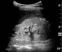 Nephrotic syndrome. Hyperechoic kidney without demarcation of cortex and medulla.