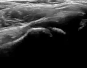 Normal ultrasound appearance of the femoral head-neck junction.