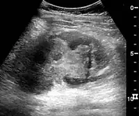 Renal ultrasonograph in renal trauma with laceration of the lower pole and subcapsular fluid collection below the kidney.