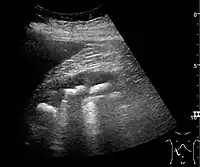 Figure 20. Staghorn calculi filling the entire collecting system and creating pronounced shadowing.