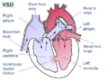 Ventricular septal defect