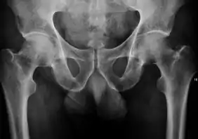 X-ray of a patient with transient osteoporosis of the left hip showing osteoporosis.