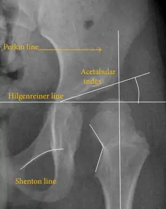 Figure 2B. Hip dysplasia.