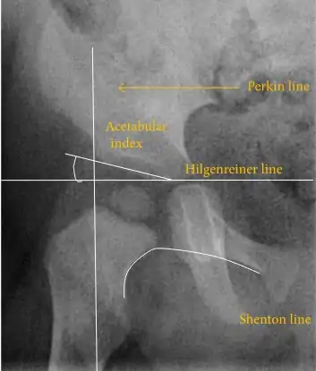 Figure 2A. Normal hip.