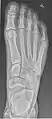 Normal right foot by dorsoplantar projection