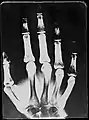 Original: X-Ray image of right Hand;1st. order equidensities after pseudo-solarization of original